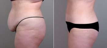 Classic Tummy Tuck Patient 13