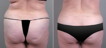 Classic Tummy Tuck Patient 13