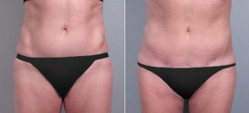 Classic Tummy Tuck Patient 17