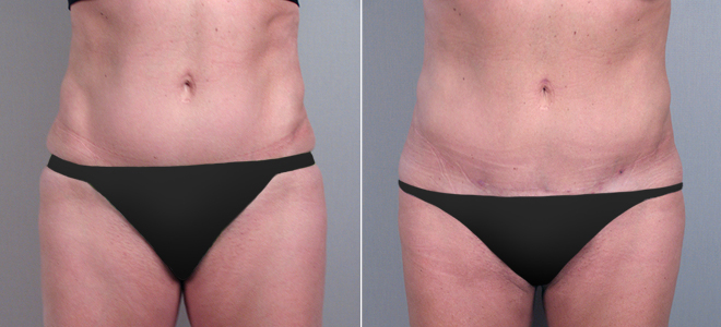Classic Tummy Tuck Patient 17