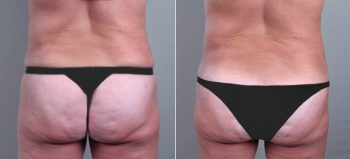 Classic Tummy Tuck Patient 17
