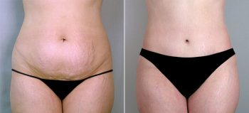 Classic Tummy Tuck Patient 15