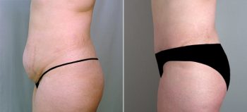 Classic Tummy Tuck Patient 15