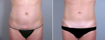 Classic Tummy Tuck Patient 18 (Classic Mini Tummy Tuck)