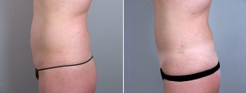 Classic Tummy Tuck Patient 18 (Classic Mini Tummy Tuck)