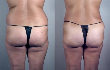 Liposuction Patient 29