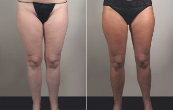 Liposuction Patient 30