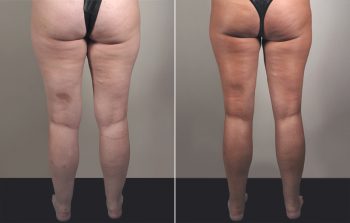 Liposuction Patient 30