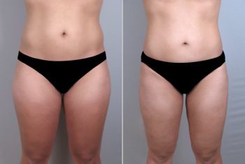 Liposuction Patient 14