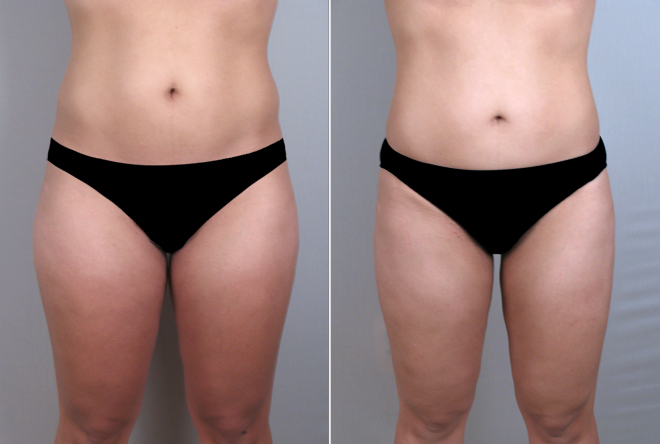 Liposuction Patient 14
