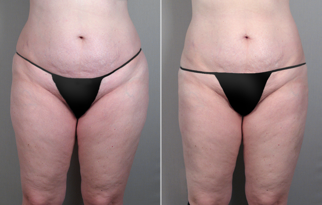 Liposuction Patient 15