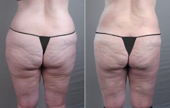 Liposuction Patient 15