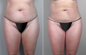 Liposuction Patient 16