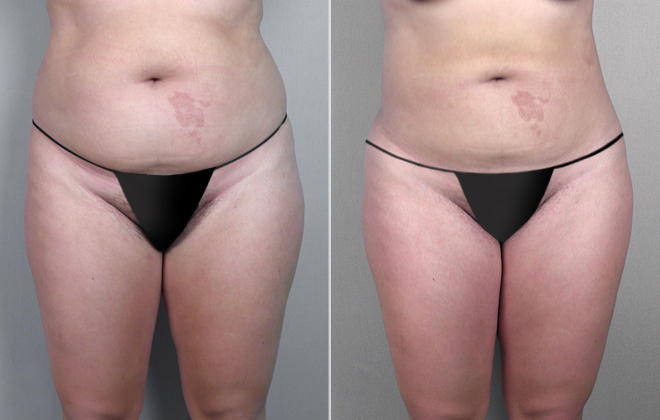 Liposuction Patient 16