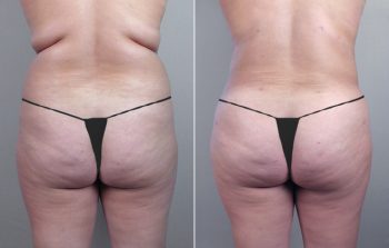 Liposuction Patient 16