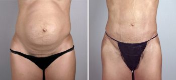 Tummy Tuck Patient 1