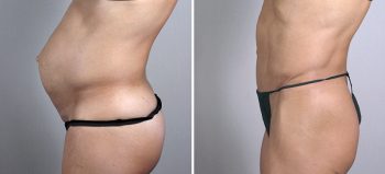 Tummy Tuck Patient 1