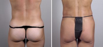Tummy Tuck Patient 1