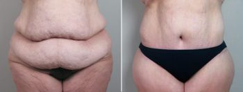 Post Bariatric Surgery Patient 2