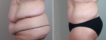 Post Bariatric Surgery Patient 2