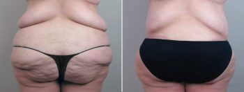 Post Bariatric Surgery Patient 2