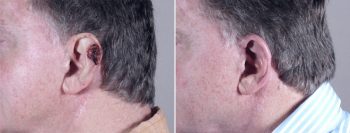 Skin Cancer Treatment Patient 10