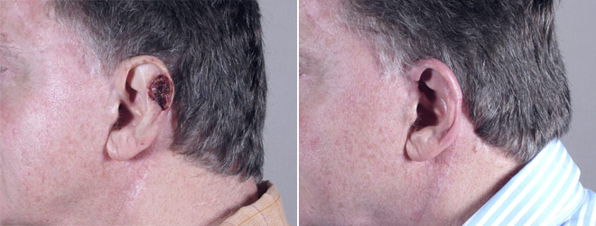 Skin Cancer Treatment Patient 10