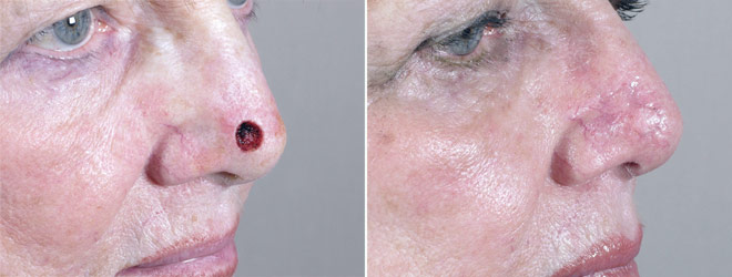 Skin Cancer Treatment Patient 11