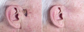 Skin Cancer Treatment Patient 12