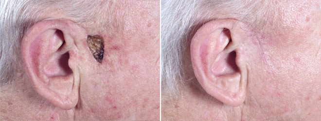 Skin Cancer Treatment Patient 12