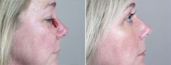 Skin Cancer Treatment Patient 13