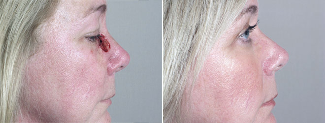Skin Cancer Treatment Patient 13