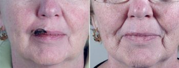 Skin Cancer Treatment Patient 9