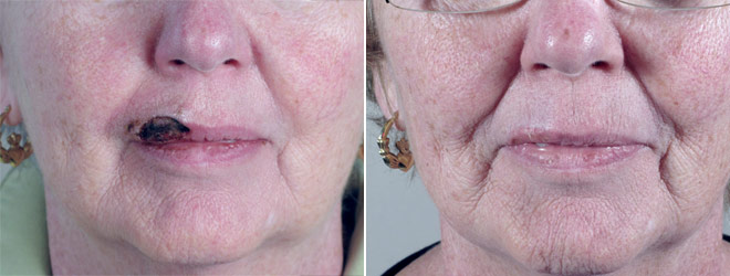 Skin Cancer Treatment Patient 9