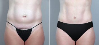 Classic Tummy Tuck Patient 7
