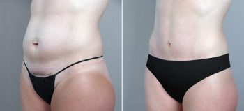 Classic Tummy Tuck Patient 7