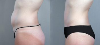 Classic Tummy Tuck Patient 7