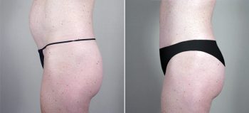 Classic Tummy Tuck Patient 9