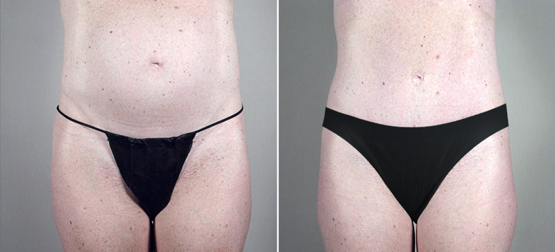 Classic Tummy Tuck Patient 9