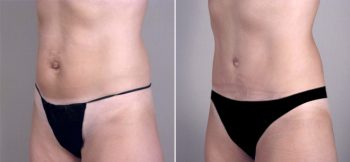 Classic Tummy Tuck Patient 20