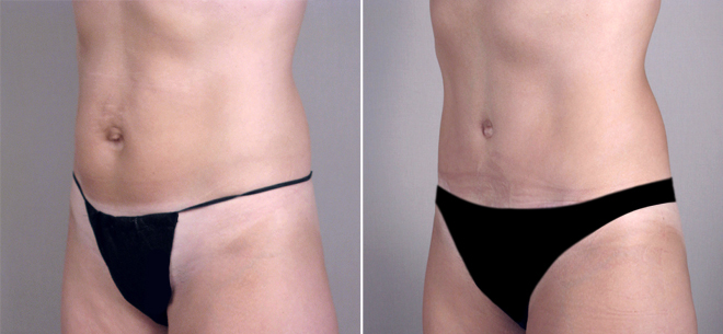 Classic Tummy Tuck Patient 20
