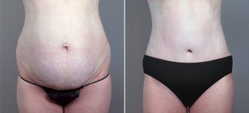 Classic Tummy Tuck Patient 6