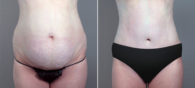 Classic Tummy Tuck Patient 6