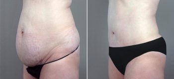 Classic Tummy Tuck Patient 6