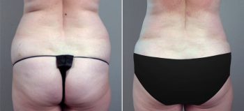 Classic Tummy Tuck Patient 6