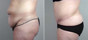 Classic Tummy Tuck Patient 14