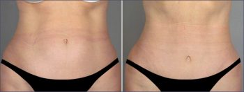 Classic Tummy Tuck Patient 2