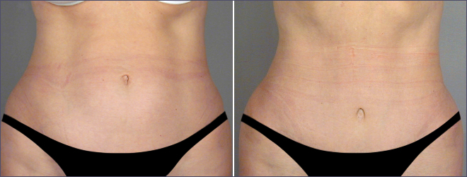 Classic Tummy Tuck Patient 2