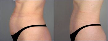Classic Tummy Tuck Patient 2