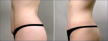 Classic Tummy Tuck Patient 4